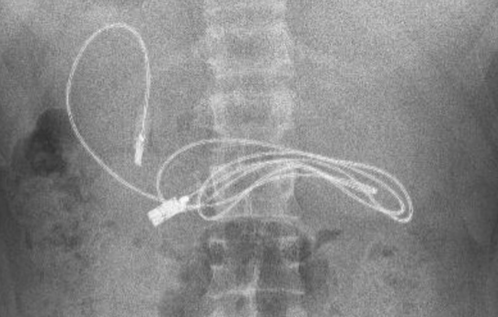 Imagen de la radiografía del adolescente en la que detectan un cable USB y una goma para el pelo.  prof.dr.yasardogan