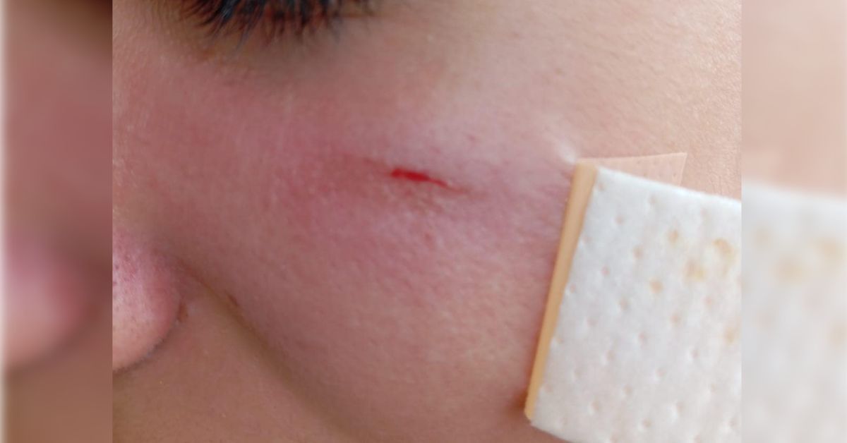 Una de las heridas sufrida por la joven agredida por tres compañeras en un instituto de Jerez.